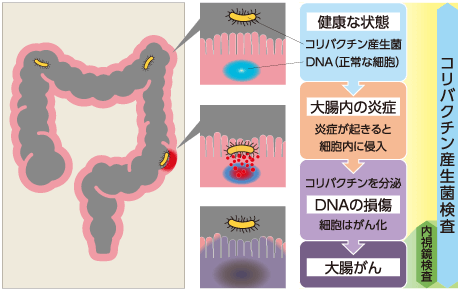 大腸がんリスクを調べる「コリバクチン検査」